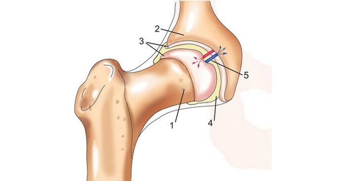 articulação do quadril e artrose