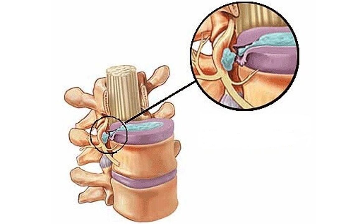 hérnia intervertebral com osteocondrose torácica